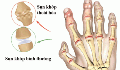 Chữa đau nhức xương khớp bàn tay, ngón tay thế nào