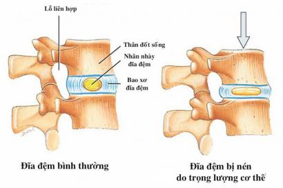 Triệu chứng và cách điều trị xẹp đĩa đệm cột sống