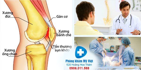  thoái hóa khớp gối